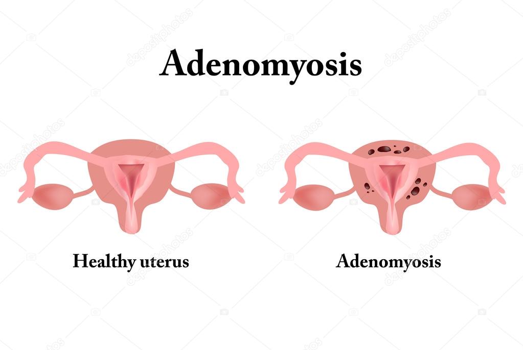 hamontfotografie | project taboe | endometriose | adenomyose